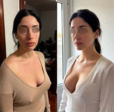 mastopexia antes y despues | testimonio 1