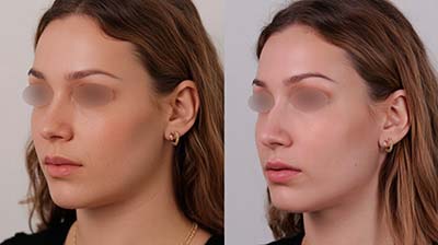 rinoseptoplastia | testimonio 1